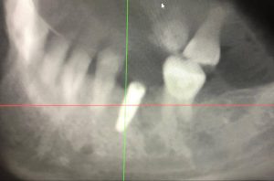 3D Guided Dental Implant Surgery