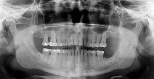 Dental-X-rays-2