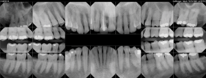 Full Mouth Series X-Rays