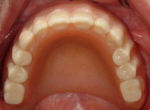 Denture-3