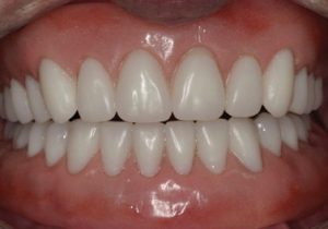 Implant-Assisted-Dentures-1