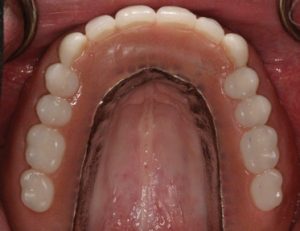 Implant-Assisted-Dentures-3