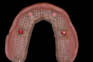 Implant-Assisted-Dentures-4