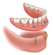 Implant-Assisted-Dentures-5