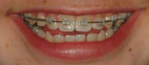 clear brackets