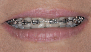 metal braces