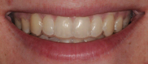 clear aligner trays