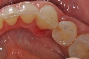 Mouth-Lesions-Colored-Areas-1