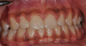 Mouth-Lesions-Colored-Areas-2