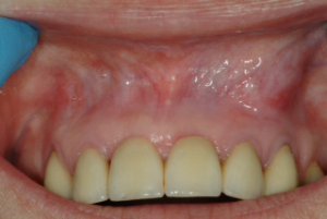 Dental Abscess