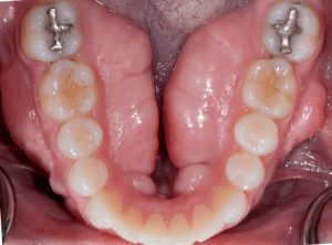 Mouth-Lesions-Swelling-3