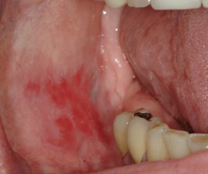 Mouth-Lesions-Ulcers-1