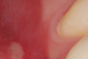 Mouth-Lesions-Ulcers-2