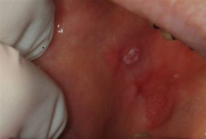 Mouth-Lesions-White-Spots-1