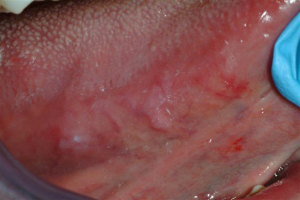 Mouth-Lesions-White-Spots-2