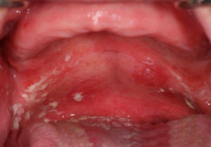 Mouth-Lesions-White-Spots-3