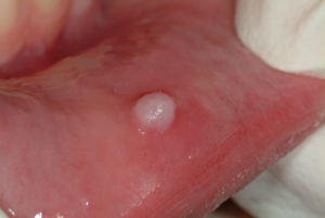 Mouth-Lesions-White-Spots-4