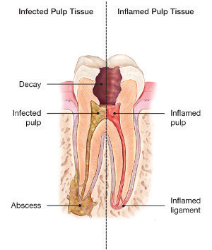 Root-Canal-Treatment-1