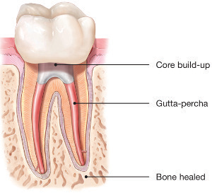 Root-Canal-Treatment-2