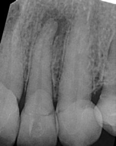Root-Canal-Treatment-3