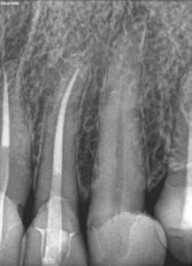 Root-Canal-Treatment-4