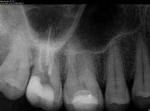 Root-Canal-Treatment-5