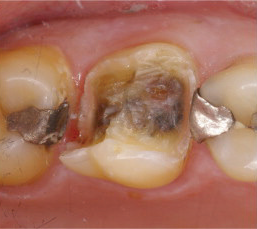 Silver-Fillings-Removed-12