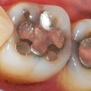 Silver-Fillings-Removed-2