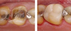 Silver-Fillings-Removed-3