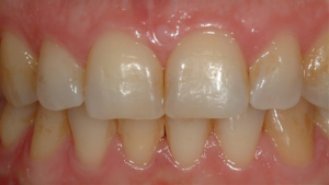 Teeth-Bleaching-2