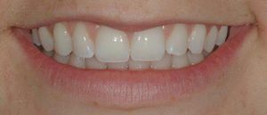 Teeth-Bleaching-3