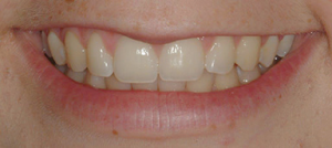 Teeth-Bleaching-4