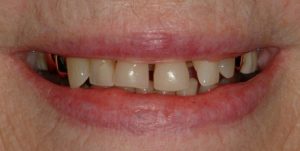 Tooth-Colored-Filling-3