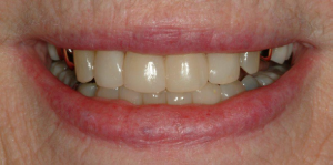 Tooth-Colored-Filling-4