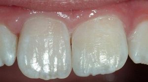 Tooth-Colored-Filling-5