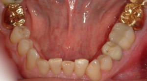 Tooth-Supported-Crown-5