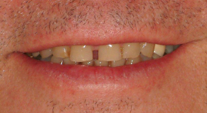 Veneers-1