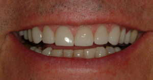 Veneers-2