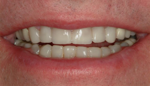 Veneers-5