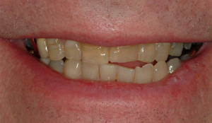 Veneers-6