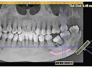 CBCT-Scan