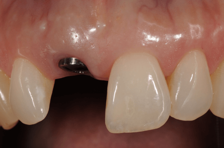 Dental-Implants-3