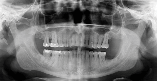 Dental-X-rays