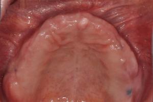 Mouth-Lesions-Colored-Areas