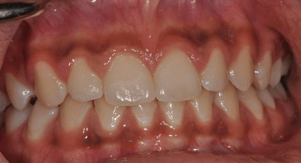 Mouth-Lesions-Colored-Areas