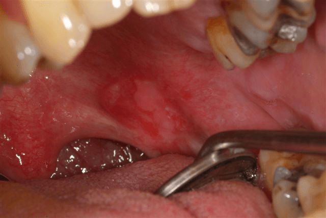 Mouth-Lesions-Swelling-4