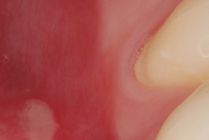 Mouth-Lesions-Ulcers