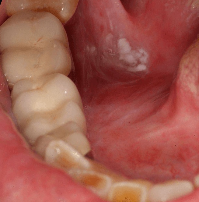 Mouth-Lesions-Ulcers-3