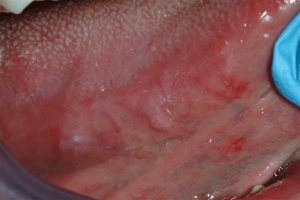Mouth-Lesions-White-Spots