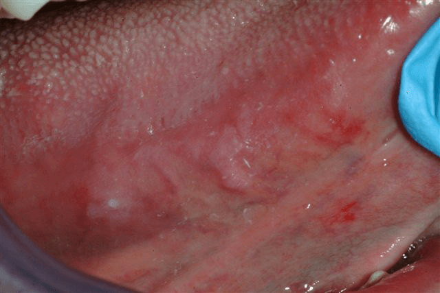 Mouth-Lesions-White-Spots